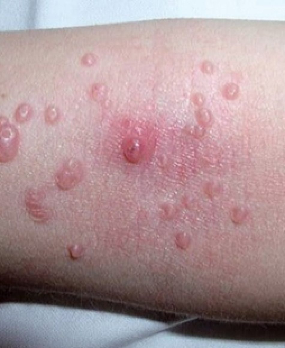 Lesões do molusco na pele.