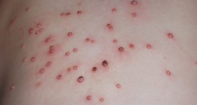 molusco contagioso tea tree melaleuca